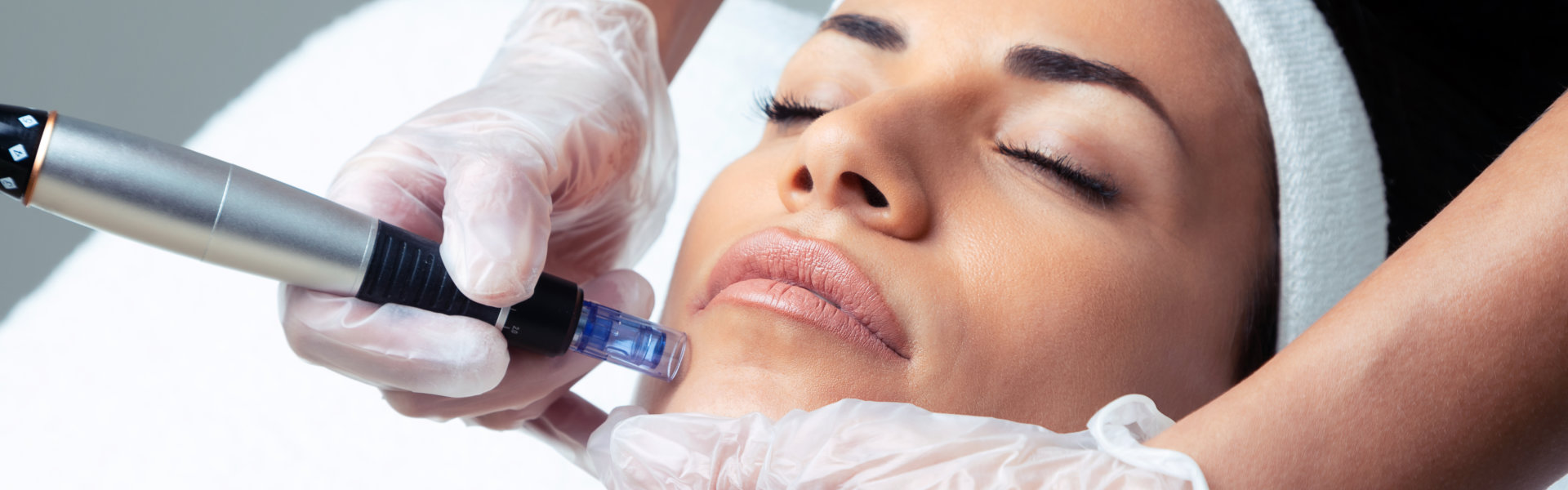 microneedling